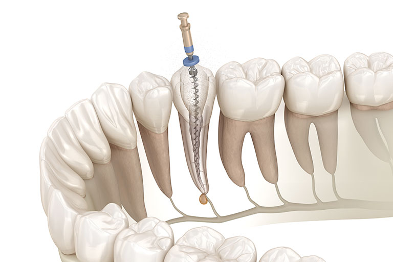 根管治療とは